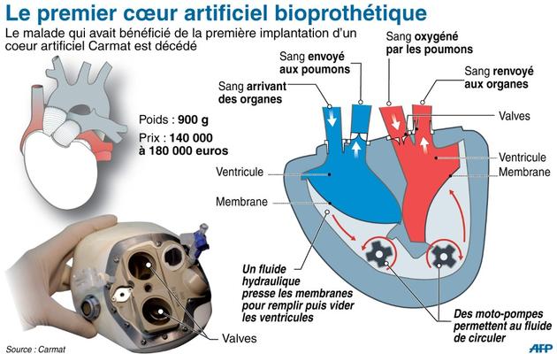 Coupe du coeur artificiel total implanté sur un malade, décédé le 2 mars 2014 [L. Saubadu/P. Defosseux / AFP]